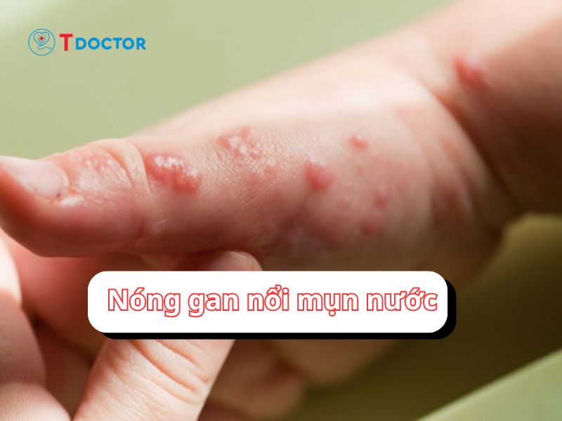 Nóng gan nổi mụn nước: nguyên nhân và cách khắc phục hiệu quả